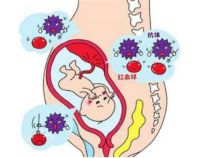 新生儿溶血性黄疸怎么治疗 什么是溶血性黄疸