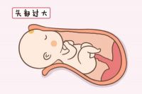 胎儿头扁属于畸形吗 胎儿头扁是什么原因