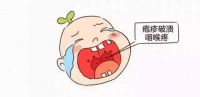 手足口接触后几天发病 手足口病传播途径有哪些